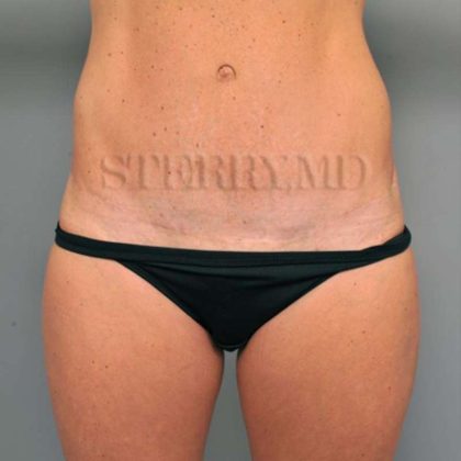 Tummy Tuck Before & After Patient #338