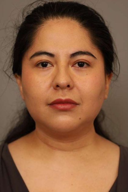 Mini Neck Lift (Single Incision) Before & After Patient #1662
