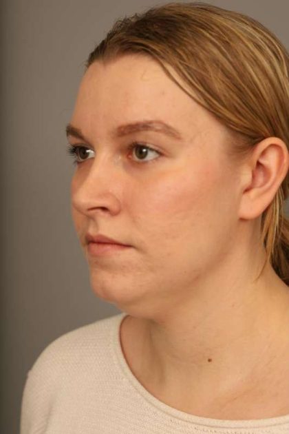 Mini Neck Lift (Single Incision) Before & After Patient #1690