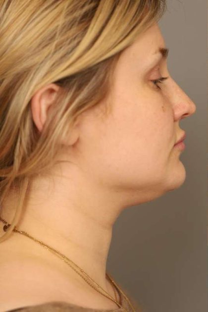 Neck Liposuction / Chin Liposuction Before & After Patient #1703