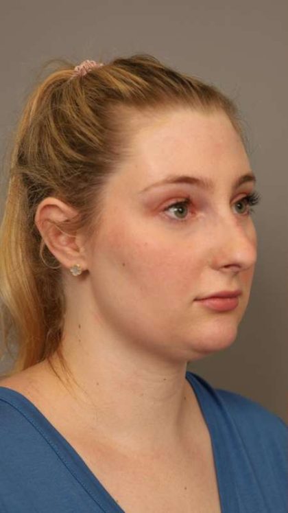 Neck Liposuction / Chin Liposuction Before & After Patient #1734
