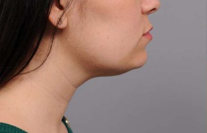 Neck Liposuction / Chin Liposuction Before & After Patient #1770