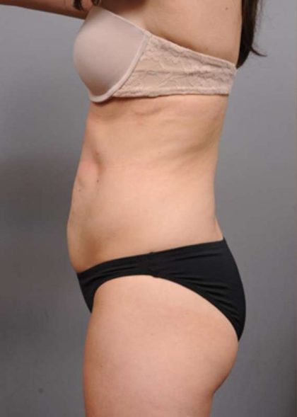 Tummy Tuck Before & After Patient #354