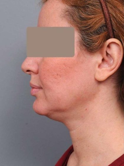 Neck Liposuction / Chin Liposuction Before & After Patient #1946