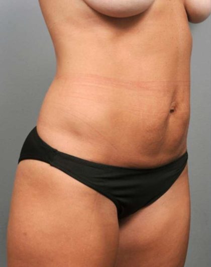 Tummy Tuck Before & After Patient #363