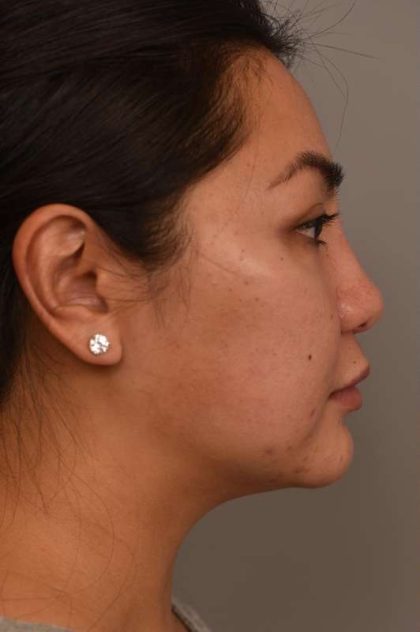 Cheek Liposuction Before & After Patient #2136