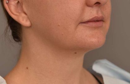 Cheek Liposuction Before & After Patient #2165