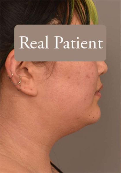 Cheek Liposuction Before & After Patient #2179