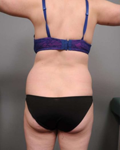 Tummy Tuck Before & After Patient #386