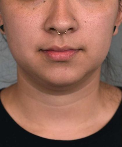 Chin Implant Before & After Patient #2278