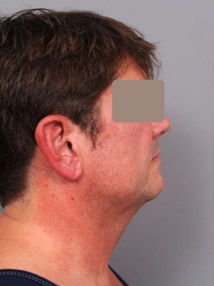 IPL Photofacial Before & After Patient #2559