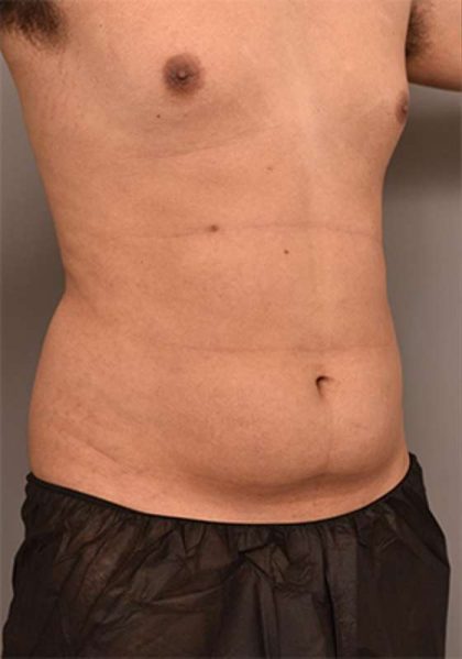 Liposuction Before & After Patient #749
