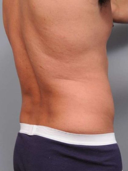 Liposuction Before & After Patient #783