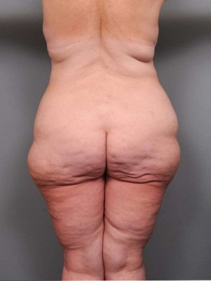 Lower Body Lift Before & After Patient #916