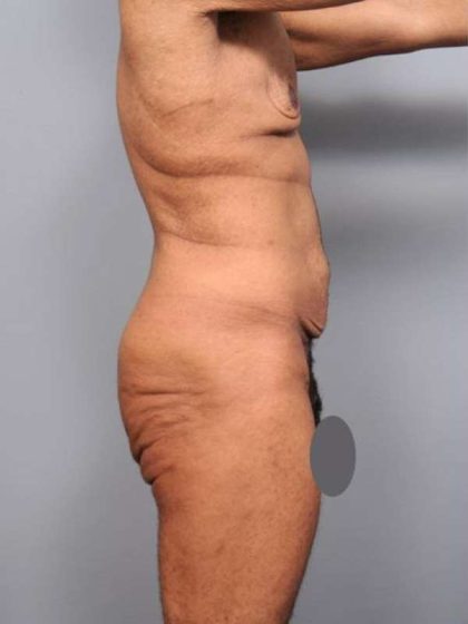 Lower Body Lift Before & After Patient #952