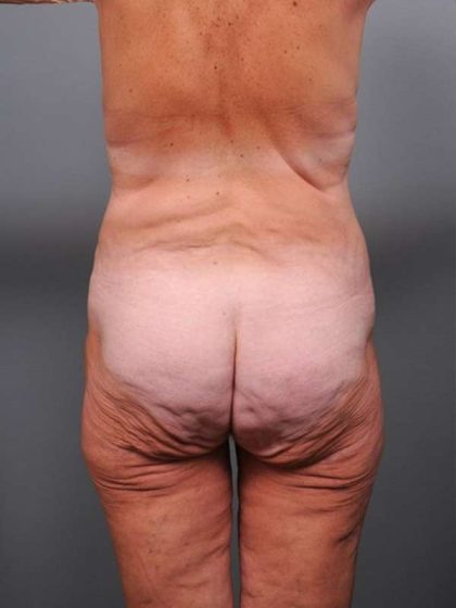 Lower Body Lift Before & After Patient #965