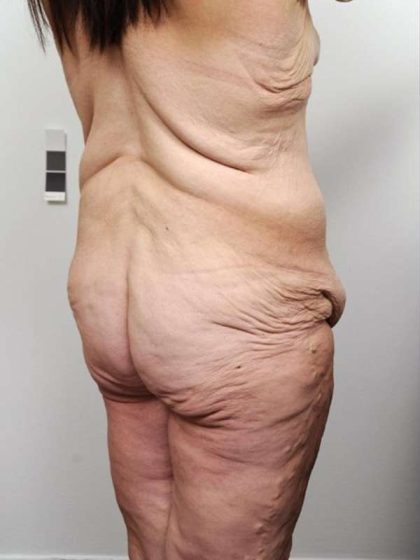 Lower Body Lift Before & After Patient #985