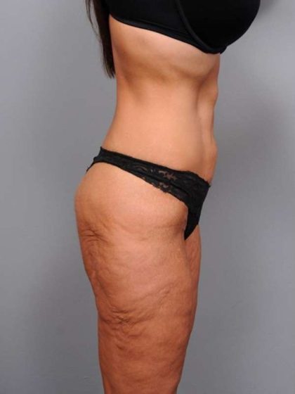Lower Body Lift Before & After Patient #1010