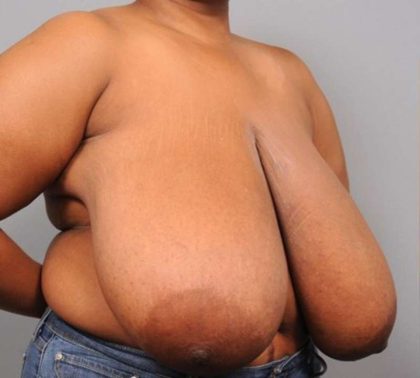 Breast Reduction Before & After Patient #1293