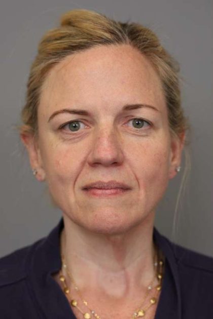Facelift Before & After Patient #1371