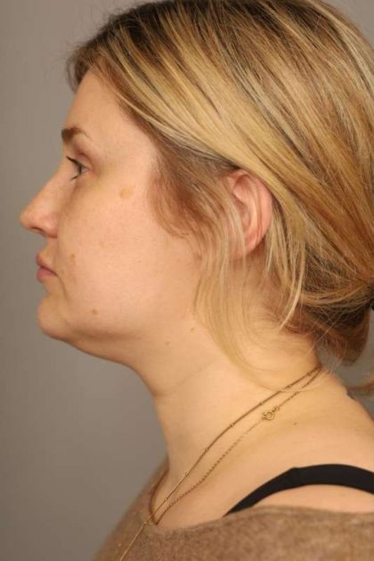 Neck Liposuction / Chin Liposuction Before & After Patient #1703