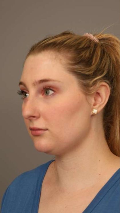 Neck Liposuction / Chin Liposuction Before & After Patient #1734