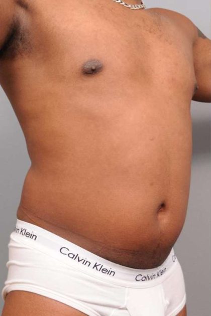 Liposuction For Men Before & After Patient #2330