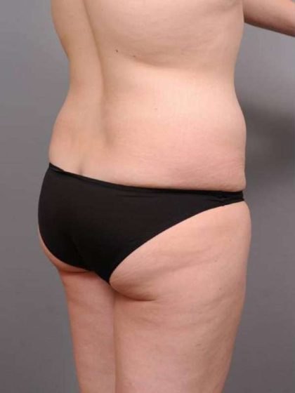Tummy Tuck Before & After Patient #463