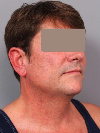 Neck Liposuction For Men Before & After Patient #2419
