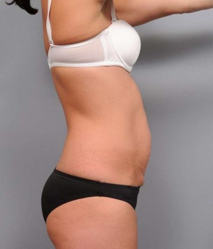 Tummy Tuck Before & After Patient #474