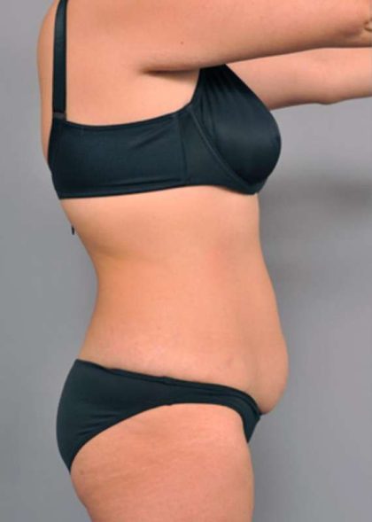 Tummy Tuck Before & After Patient #515