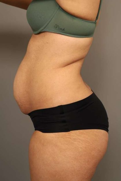 Liposuction Before & After Patient #550