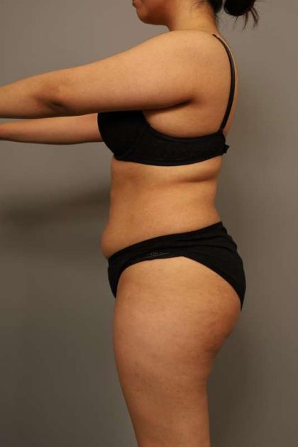 Liposuction Before & After Patient #563