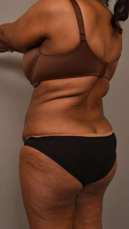 Tummy Tuck Before & After Patient #574