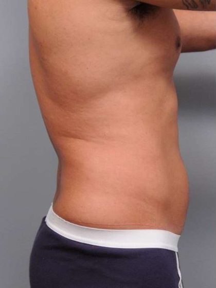 Liposuction For Men Before & After Patient #2386