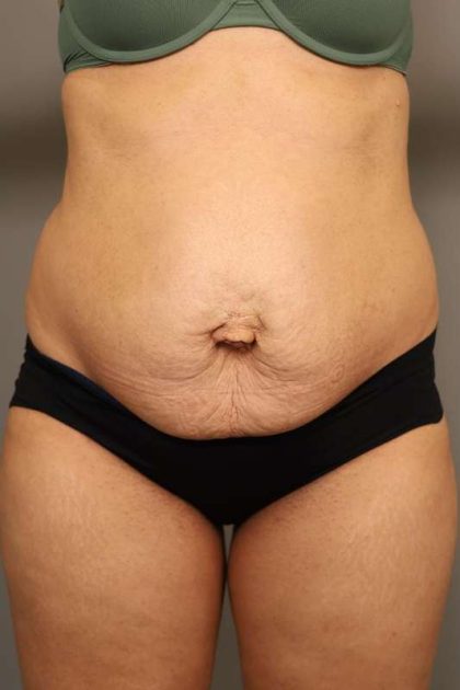 Liposuction Before & After Patient #550