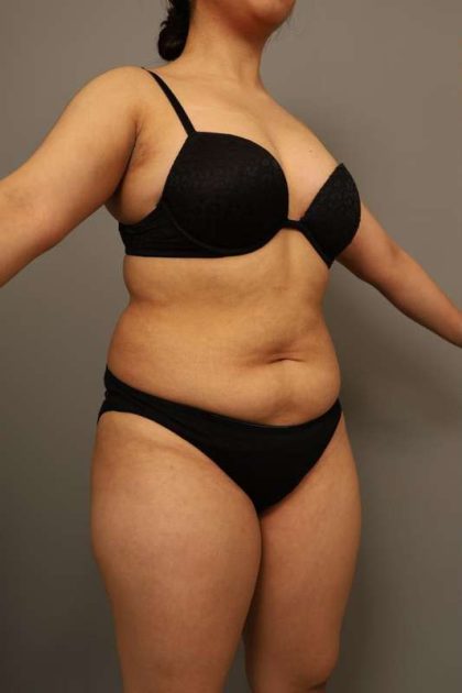 Liposuction Before & After Patient #563