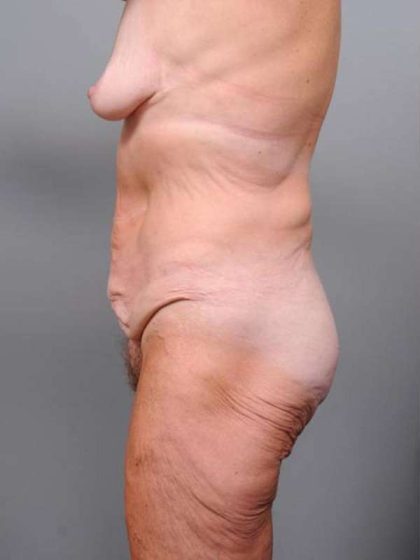 Lower Body Lift Before & After Patient #965