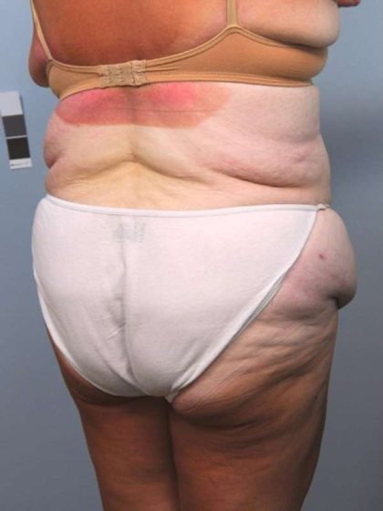 Lower Body Lift Before & After Patient #1027