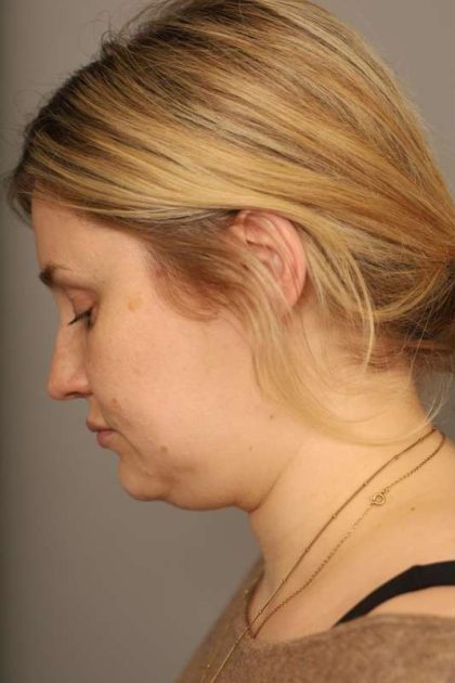 Neck Liposuction / Chin Liposuction Before & After Patient #1703