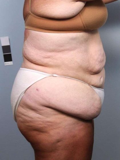 Lower Body Lift Before & After Patient #1027