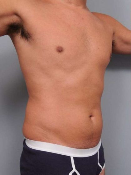 Liposuction Before & After Patient #783