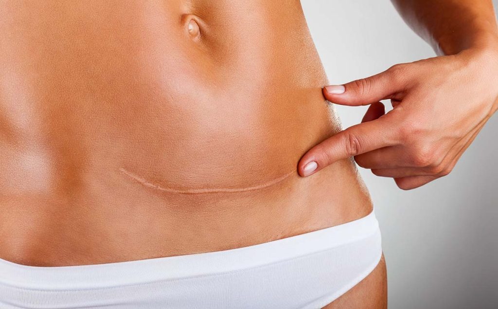 Scar Revision